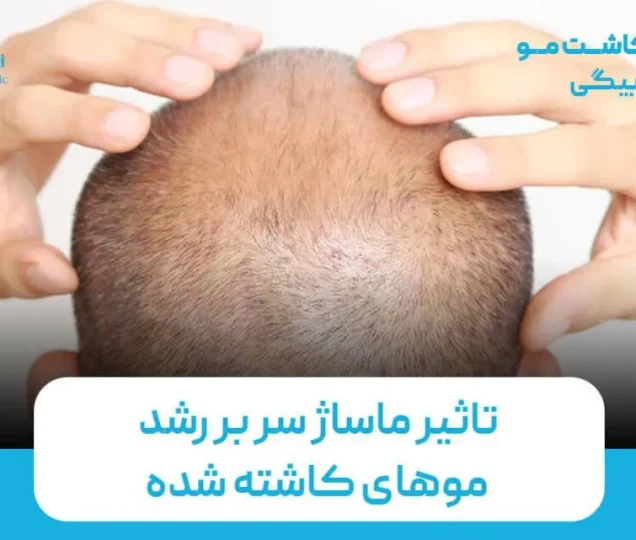 ماساژ سر بعد از کاشت مو؛ مفید است یا مضر؟