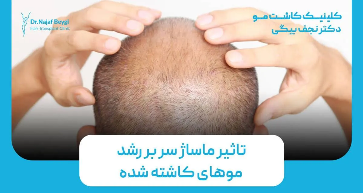 ماساژ سر بعد از کاشت مو؛ مفید است یا مضر؟
