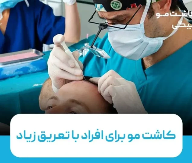 کاشت مو برای افراد با تعریق زیاد