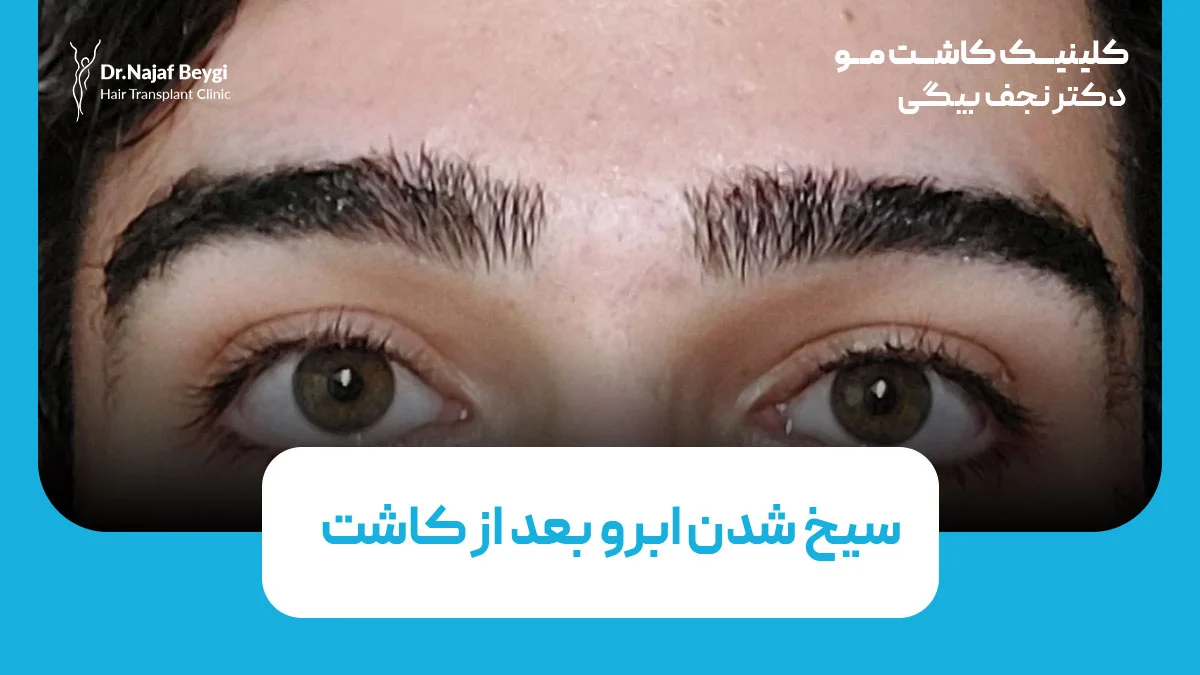 سیخ شدن ابرو بعد از کاشت