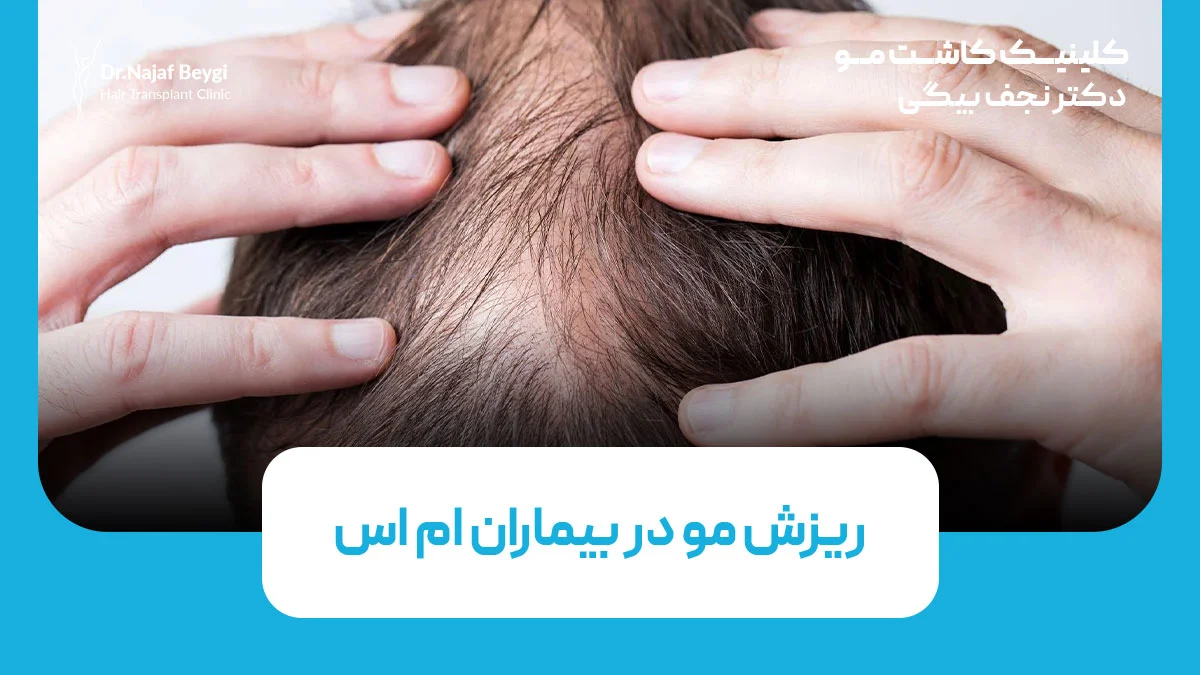 ریزش مو در بیماران ام اس