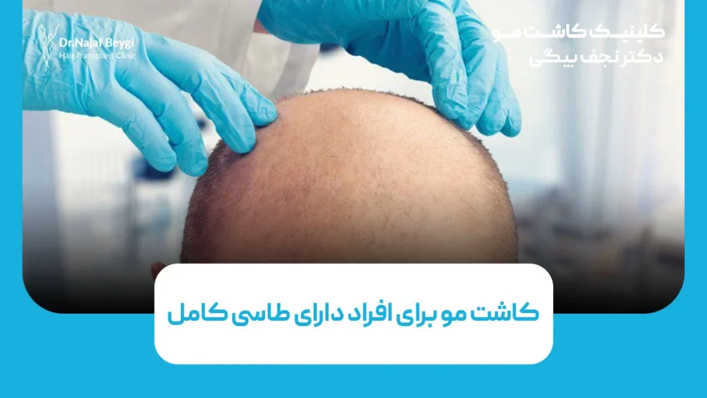 کاشت مو برای افراد دارای طاسی کامل