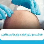 کاشت مو برای افراد دارای طاسی کامل