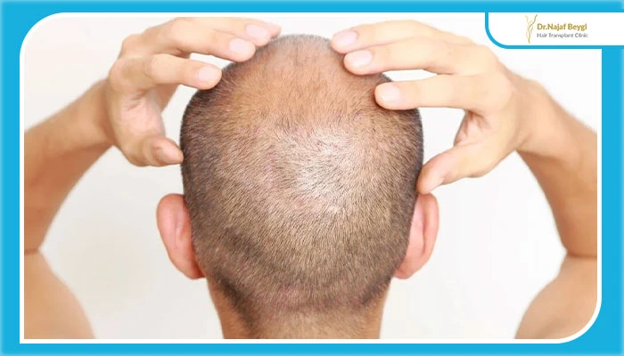 کاشت مو برای افراد دارای طاسی کامل