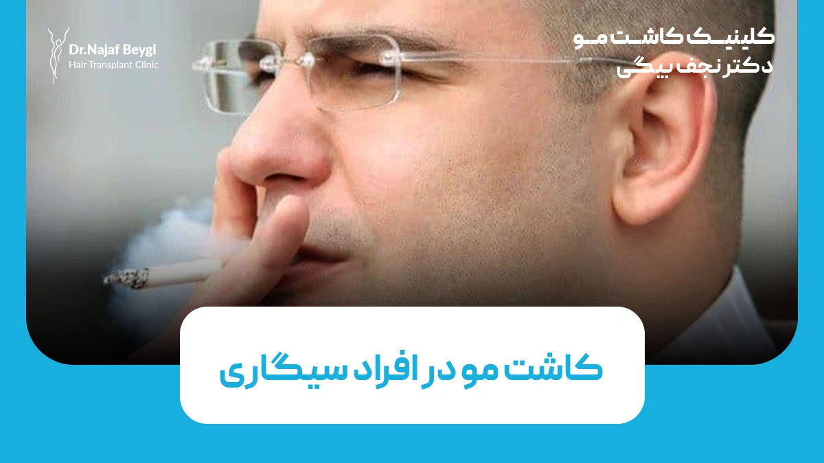 کاشت مو در افراد سیگاری