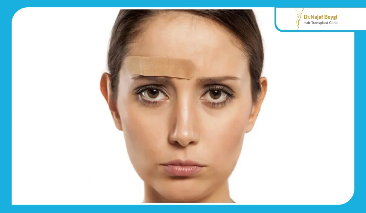 لیزر موهای زائد پیشانی