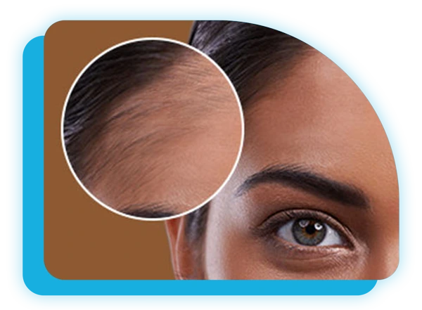 لیزر موهای زائد پیشانی