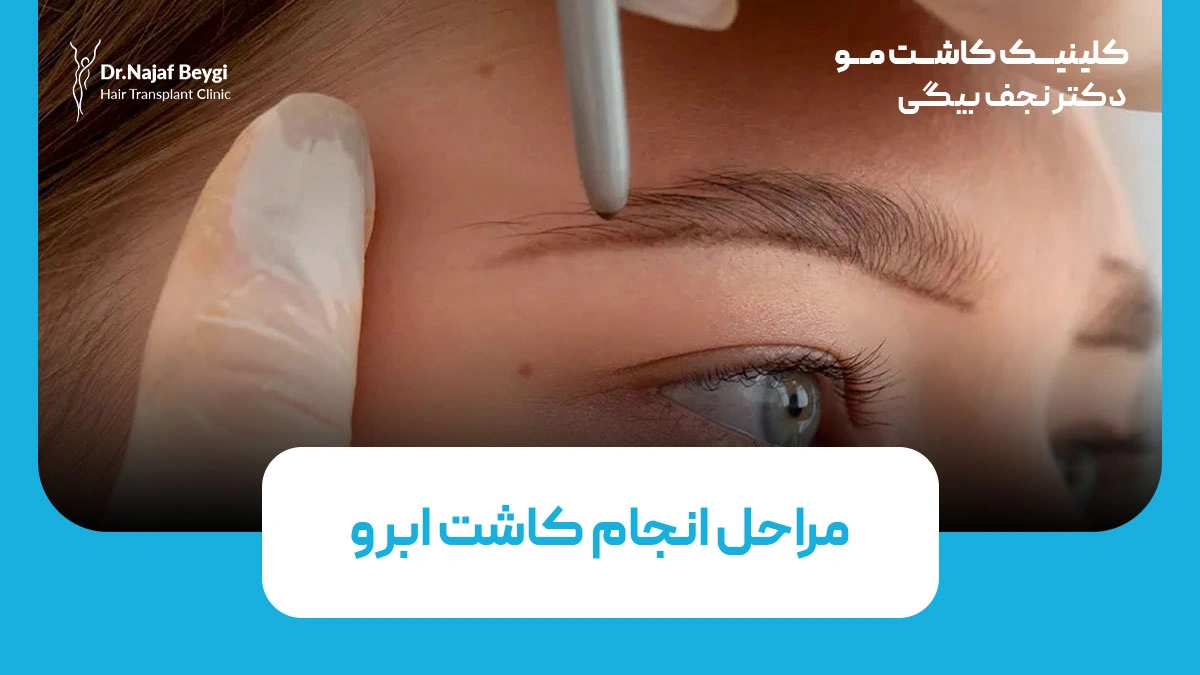 مراحل انجام کاشت ابرو