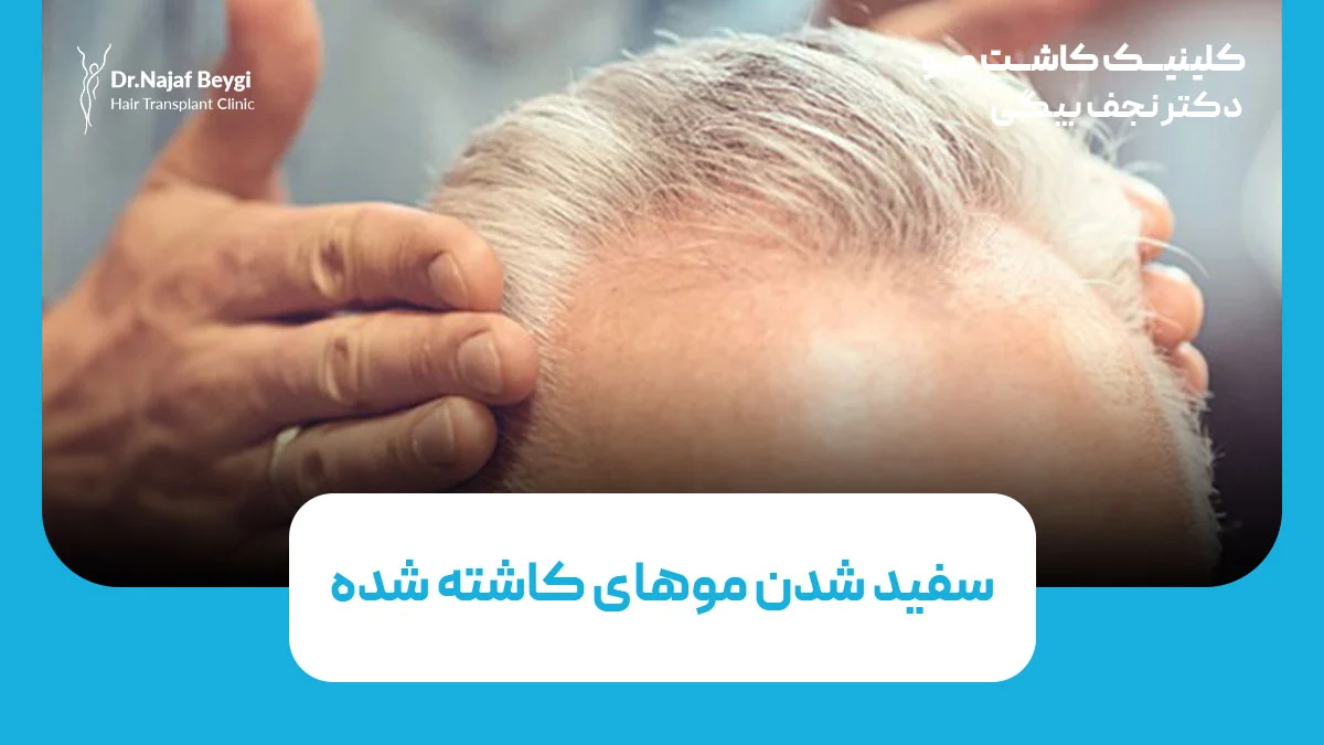 سفید شدن موهای کاشته شده