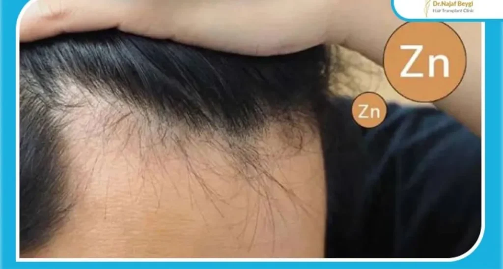 بهترین قرص بعد از کاشت مو