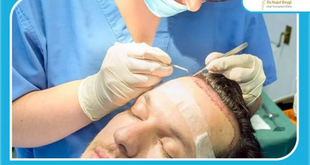 بوی بد پوست سر بعد از کاشت مو