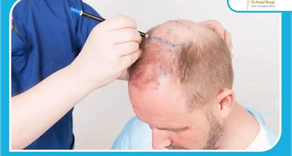 عفونت بعد از کاشت مو