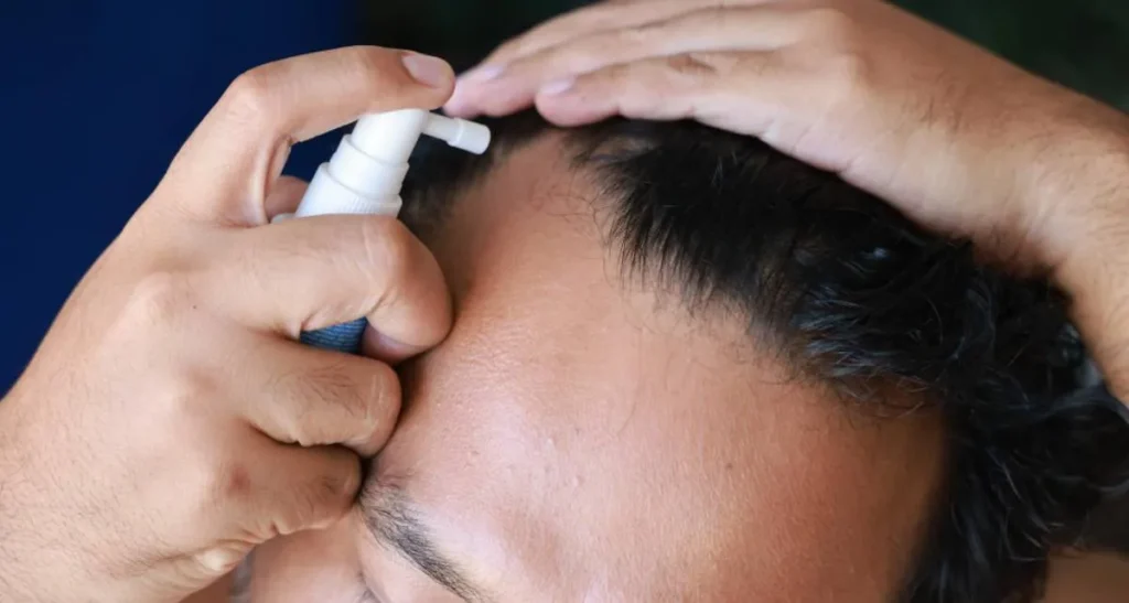 معرفی بهترین داروهای تقویتی بعد از کاشت مو