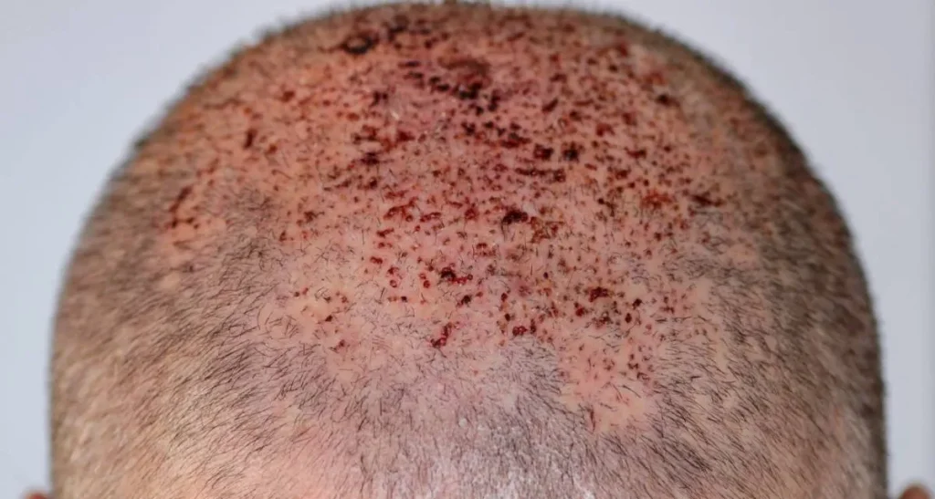 چرا پوست سر بعد از کاشت مو بوی بد می دهد؟