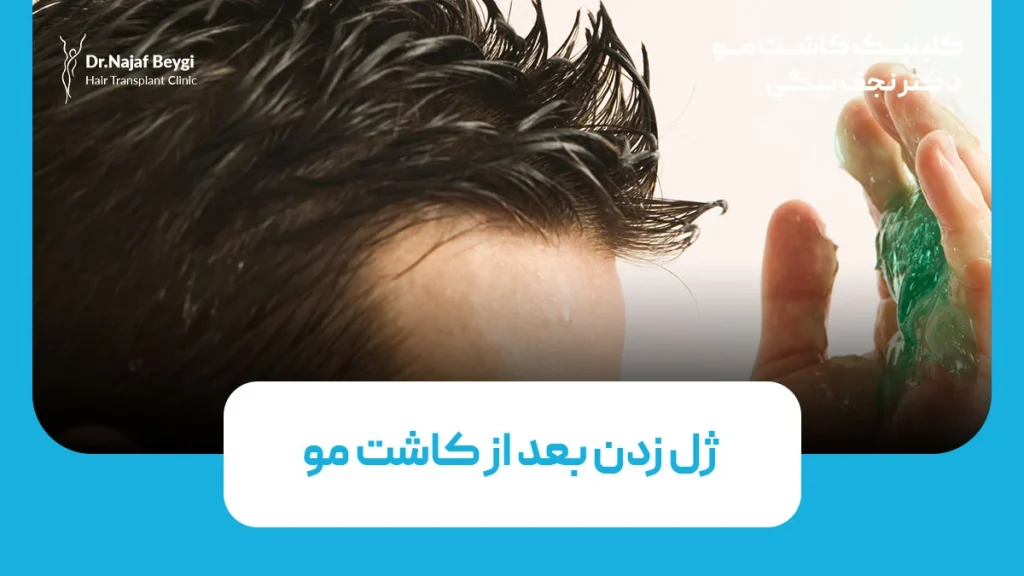 ژل زدن بعد از کاشت مو