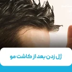 ژل زدن بعد از کاشت مو
