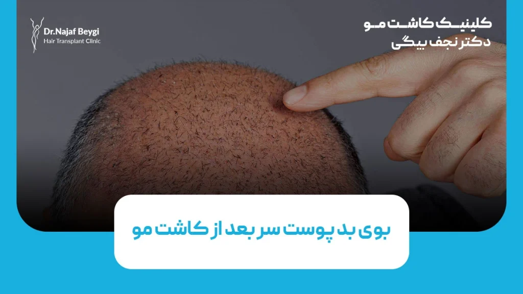 بوی بد پوست سر بعد از کاشت مو