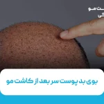 بوی بد پوست سر بعد از کاشت مو