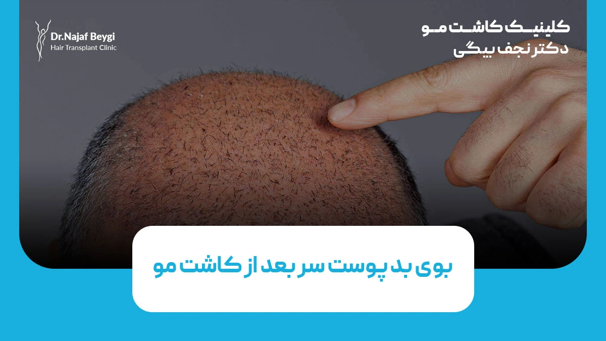 بوی بد پوست سر بعد از کاشت مو