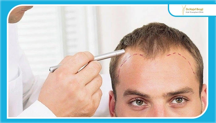 بوی بد پوست سر بعد از کاشت مو