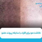 کاشت مو برای افراد با سابقه پیوند عضو
