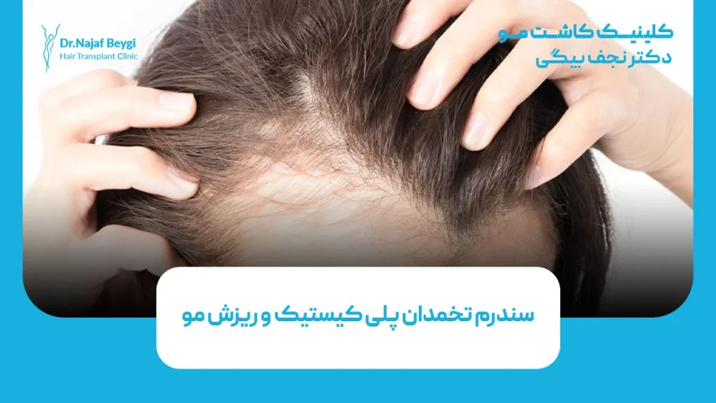 سندرم تخمدان پلی کیستیک و ریزش مو