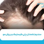 سندرم تخمدان پلی کیستیک و ریزش مو
