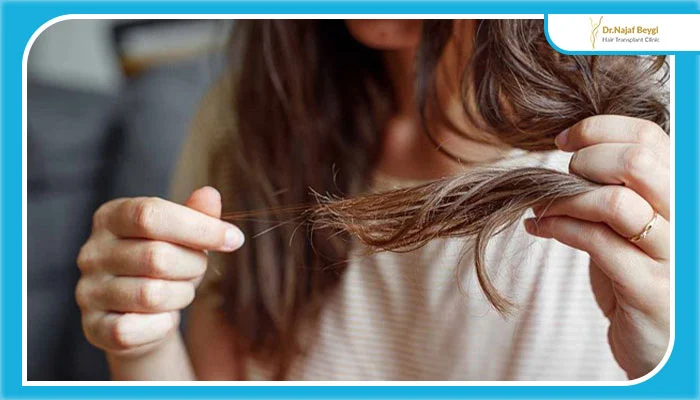 سندرم تخمدان پلی کیستیک و ریزش مو