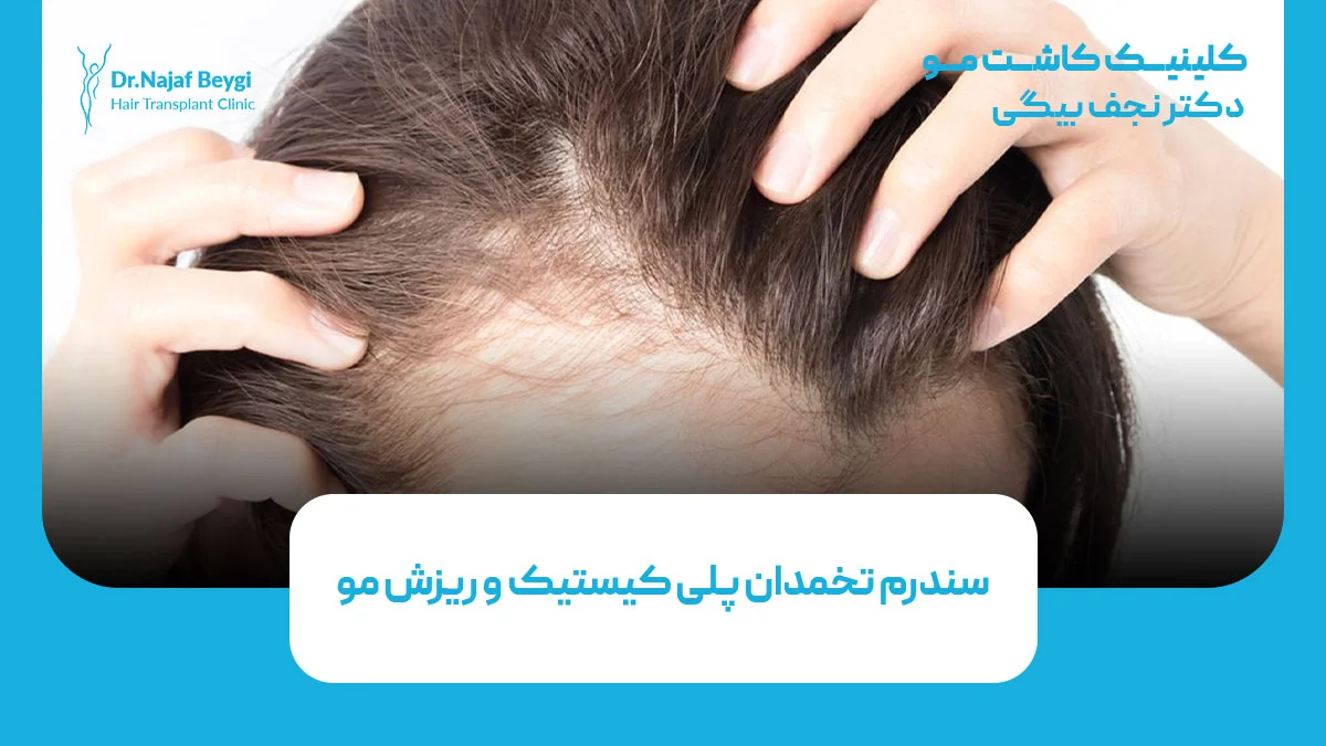سندرم تخمدان پلی کیستیک و ریزش مو