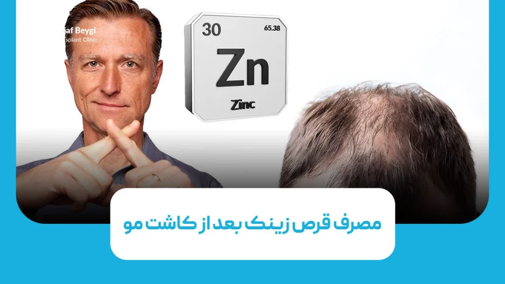 مصرف قرص زینک بعد از کاشت مو