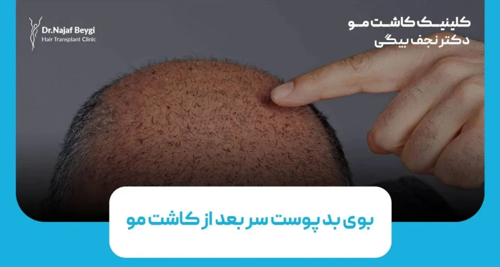  دلیل بوی بد پوست سر بعد از کاشت مو و راه درمان آن