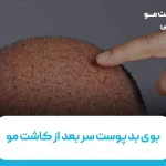 دلیل بوی بد پوست سر بعد از کاشت مو