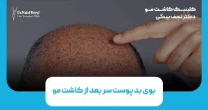 دلیل بوی بد پوست سر بعد از کاشت مو