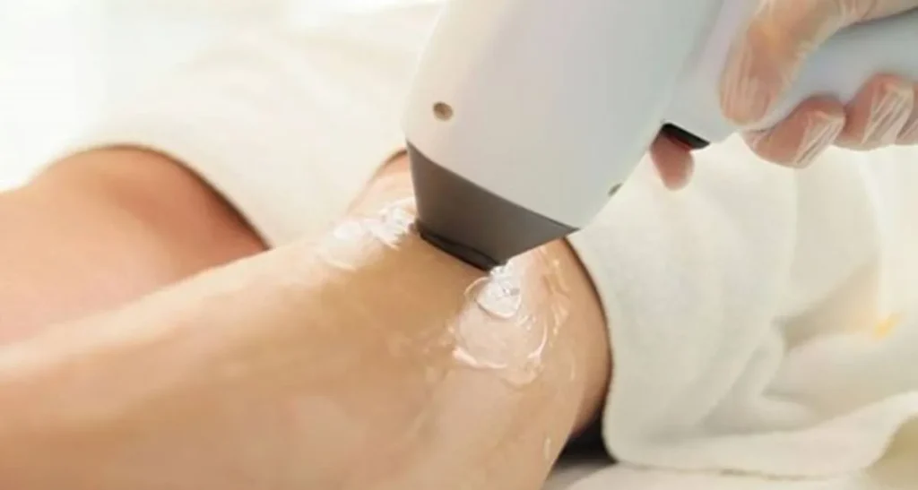 آسیب تخمدانها با لیزر موهای زائد بیکینی