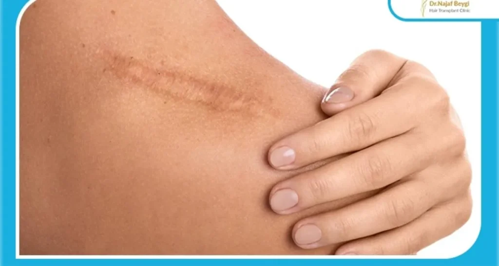 لیزر بیکینی باعث نازایی میشود