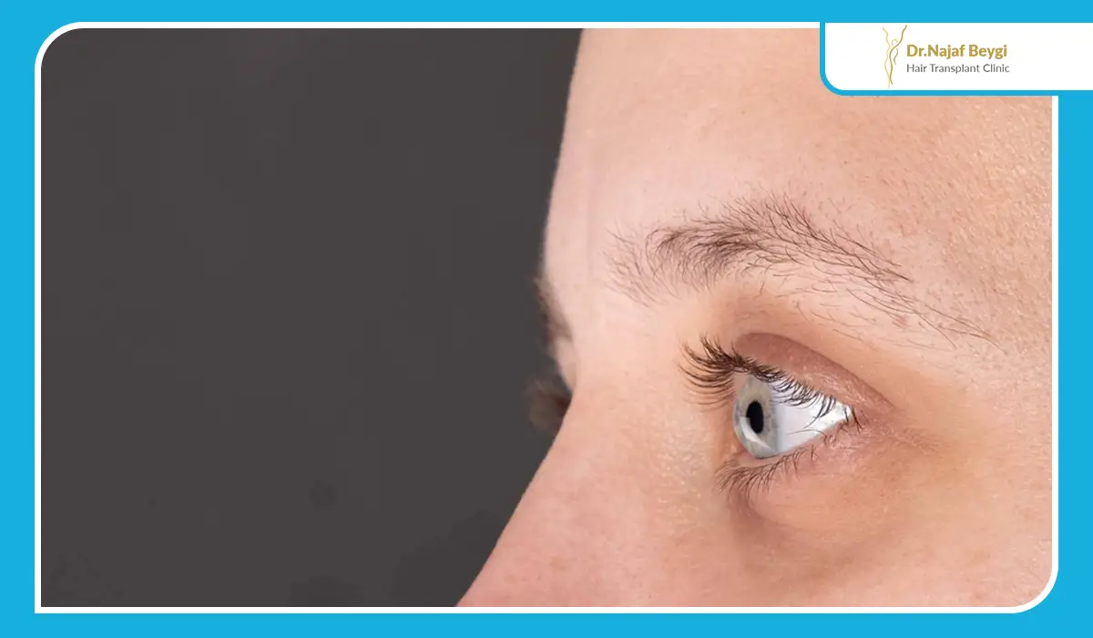 از کجا بفهمیم ریزش ابرو ژنتیکی است؟