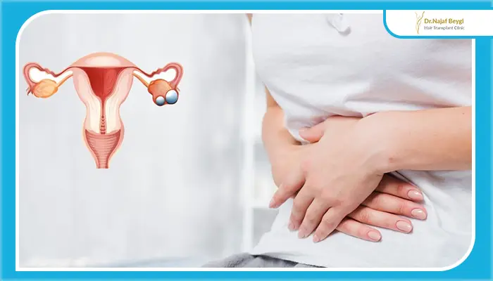 لیزر موهای زائد برای مبتلایان PCOS