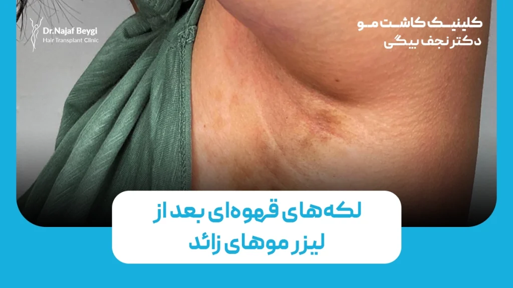 لکه‌های قهوه‌ای بعد از لیزر موهای زائد: چرا این اتفاق می‌افتد؟