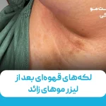 لکه‌های قهوه‌ای بعد از لیزر موهای زائد: چرا این اتفاق می‌افتد؟