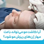 آیا کاشت مو می‌تواند باعث مهار ژن‌های ریزش مو شود