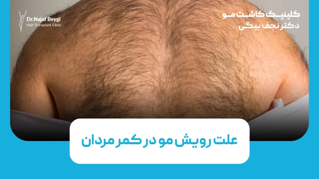 علت رویش مو در کمر مردان