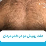 علت رویش مو در کمر مردان