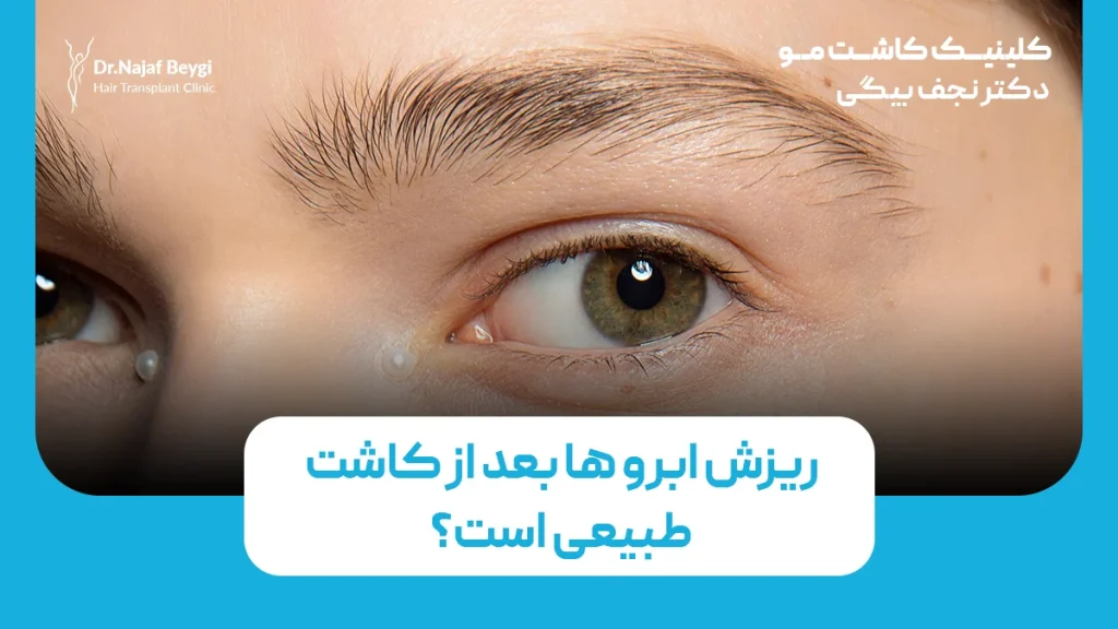 ریزش ابرو ها بعد از کاشت طبیعی است