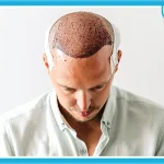 علت ضعف سیستم ایمنی بیش فعال در کاشت مو