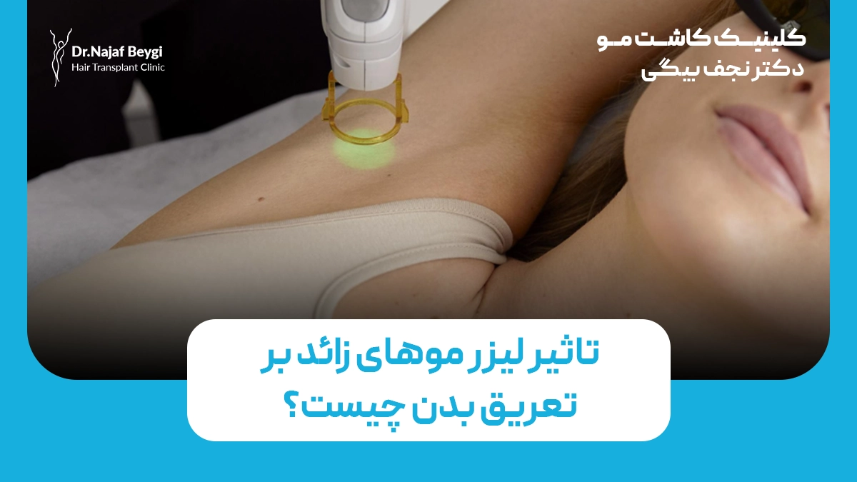 لیزر موهای زائد چه تاثیری بر تعریق بدن دارد؟