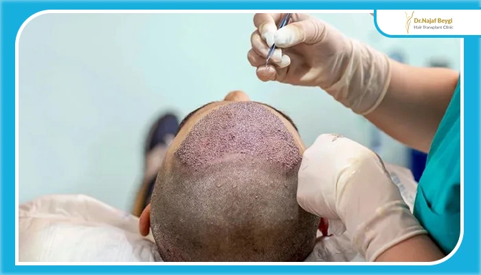 چه زمانی کاشت مو در افراد با مشکلات انعقادی خون به تاخیر می‌افتد؟