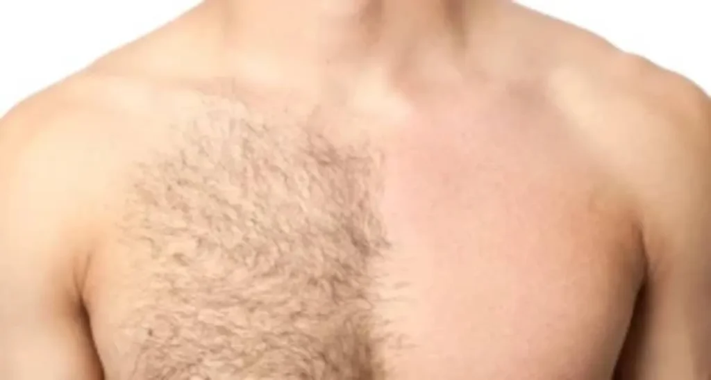 آیا لیزر موهای زائد برای افراد دارای موی ضخیم موثر است؟