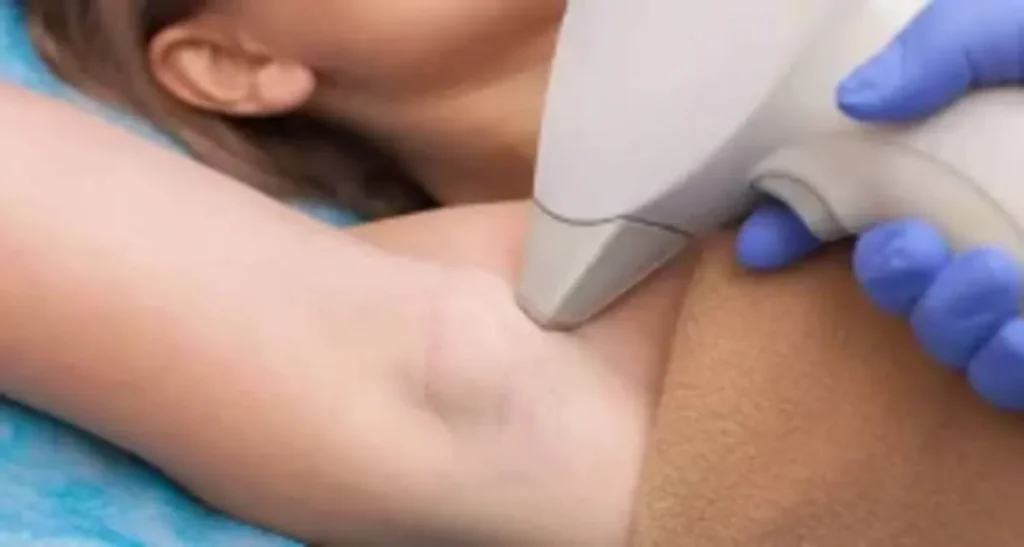 تاثیر لیزر بر موهای ضخیم