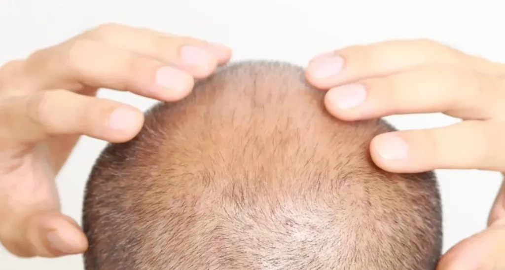 درمان ریزش مو بعد از پی آر پی