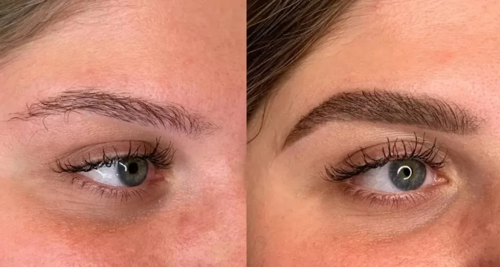 کاشت ابرو پهن دخترانه